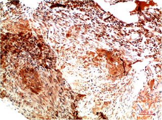 Immunohistochemistry of paraffin-embedded Human lung carcinoma tissue using COL2A1 Monoclonal Antibody at dilution of 1:200.