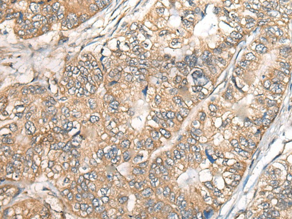 Immunohistochemistry of paraffin-embedded Human gastric cancer tissue  using BCHE Polyclonal Antibody at dilution of 1:40(?200)