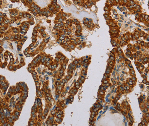 Immunohistochemistry of paraffin-embedded Human thyroid cancer using NDUFS5 Polyclonal Antibody at dilution of 1:50