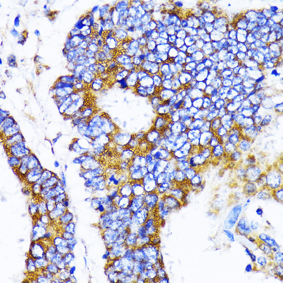 Immunohistochemistry of paraffin-embedded Human colon carcinoma using MRPL13 Polyclonal Antibody at dilution of 1:100 (40x lens).