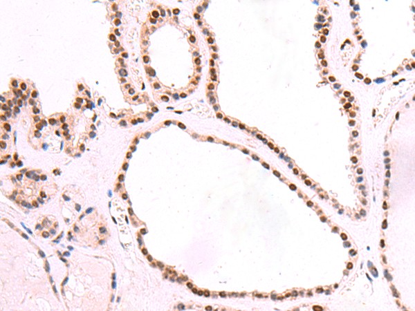 Immunohistochemistry of paraffin-embedded Human thyroid cancer tissue  using SF3B3 Polyclonal Antibody at dilution of 1:70(?200)