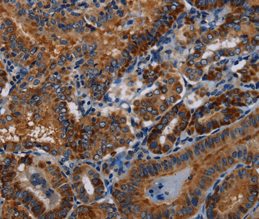 Immunohistochemistry of paraffin-embedded Human thyroid cancer tissue using PIDD1 Polyclonal Antibody at dilution 1:30