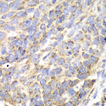 Immunohistochemistry of paraffin-embedded Human esophageal cancer using ACY1 Polyclonal Antibody at dilution of 1:100 (40x lens).