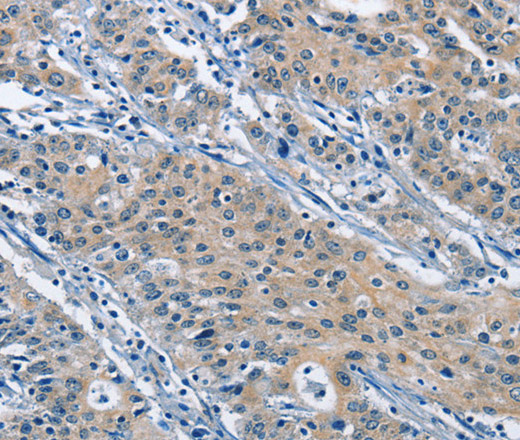 Immunohistochemistry of paraffin-embedded Human gastric cancer using KLF7 Polyclonal Antibody at dilution of 1:60