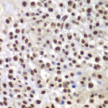 Immunohistochemistry of paraffin-embedded Mouse osteosarcoma using SMARCB1 Polyclonal Antibody at dilution of  1:200 (40x lens).