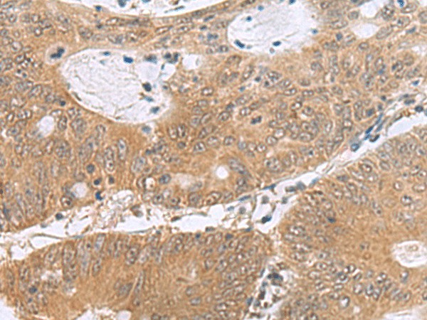 Immunohistochemistry of paraffin-embedded Human colorectal cancer tissue  using PHPT1 Polyclonal Antibody at dilution of 1:170(?200)