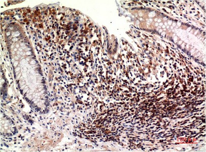 Immunohistochemistry of paraffin-embedded Human colon carcinoma tissue using Epsilon Tubulin Monoclonal Antibody at dilution of 1:200.