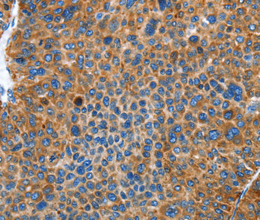 Immunohistochemistry of paraffin-embedded Human liver cancer using AUP1 Polyclonal Antibody at dilution of 1:50