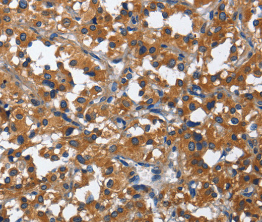 Immunohistochemistry of paraffin-embedded Human thyroid cancer using CD27 Polyclonal Antibody at dilution of 1:60