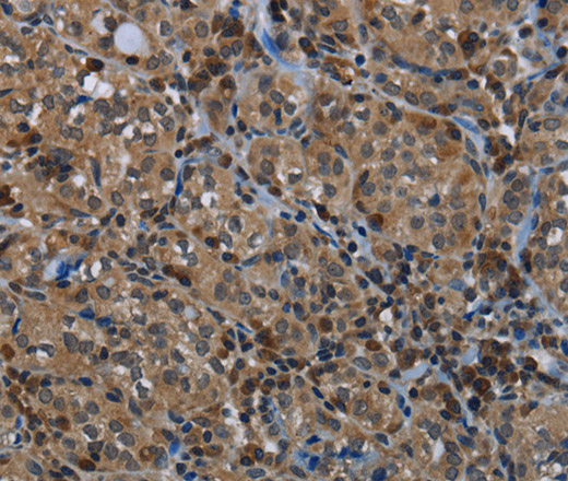 Immunohistochemistry of paraffin-embedded Human thyroid cancer using GYS1 Polyclonal Antibody at dilution of 1:40