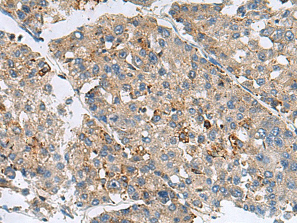 Immunohistochemistry of paraffin-embedded Human liver cancer tissue  using MED31 Polyclonal Antibody at dilution of 1:100(?200)