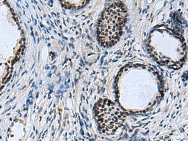 Immunohistochemistry of paraffin-embedded Human prost at e cancer tissue  using CCAR2 Polyclonal Antibody at dilution of 1:40(?200)