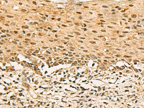 Immunohistochemistry of paraffin-embedded Human cervical cancer tissue  using SCMH1 Polyclonal Antibody at dilution of 1:120(?200)