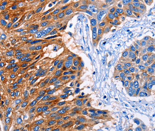 Immunohistochemistry of paraffin-embedded Human esophagus cancer tissue using CLEC2B Polyclonal Antibody at dilution 1:50