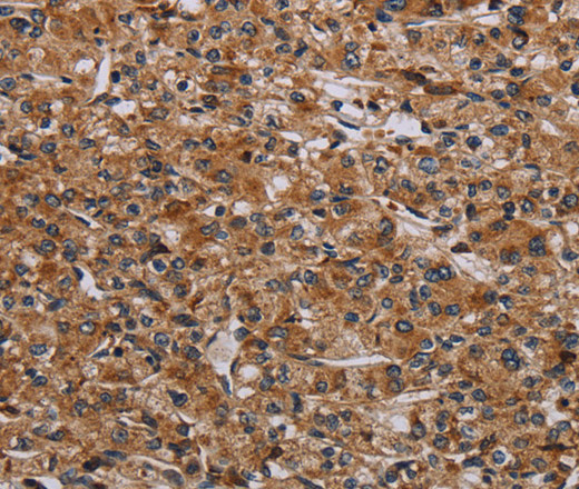 Immunohistochemistry of paraffin-embedded Human prostate cancer tissue using p70 S6 kinase beta Polyclonal Antibody at dilution 1:40