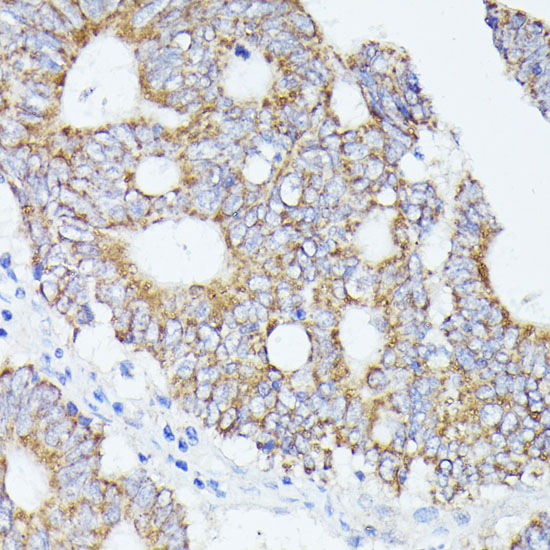 Immunohistochemistry of paraffin-embedded Human colon carcinoma using ACAT2 Polyclonal Antibody at dilution of  1:100 (40x lens).