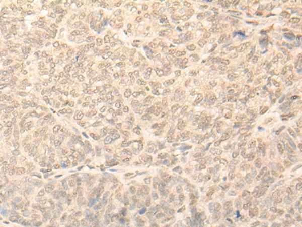 Immunohistochemistry of paraffin-embedded Human ovarian cancer tissue  using NARF Polyclonal Antibody at dilution of 1:45(?200)