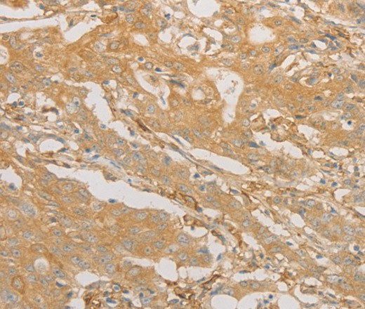 Immunohistochemistry of paraffin-embedded Human gastric cancer tissue using CD40 Polyclonal Antibody at dilution 1:70