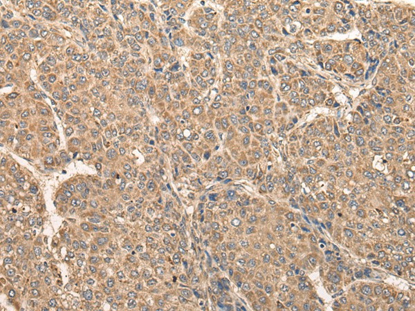 Immunohistochemistry of paraffin-embedded Human liver cancer tissue  using RCAN3 Polyclonal Antibody at dilution of 1:60(?200)