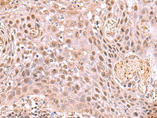 Immunohistochemistry of paraffin-embedded Human tonsil tissue  using DDI2 Polyclonal Antibody at dilution of 1:75(?200)