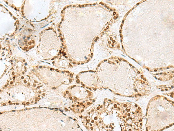 Immunohistochemistry of paraffin-embedded Human thyroid cancer tissue  using GTF3C2 Polyclonal Antibody at dilution of 1:45(?200)