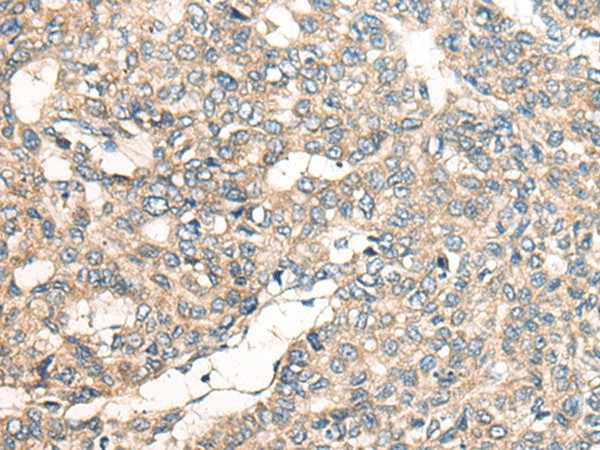 Immunohistochemistry of paraffin-embedded Human liver cancer tissue  using LRP1B Polyclonal Antibody at dilution of 1:50(?200)