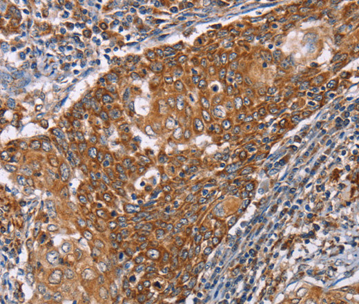 Immunohistochemistry of paraffin-embedded Human cervical cancer tissue using PMPCB Polyclonal Antibody at dilution 1:50