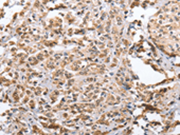 Immunohistochemistry of paraffin-embedded Human prost at e cancer tissue  using ZFYVE16  Polyclonal Antibody at dilution of 1:60(?200)