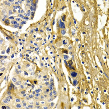 Immunohistochemistry of paraffin-embedded Human liver cancer using CFH Polyclonal Antibody at dilution of 1:200 (40x lens).