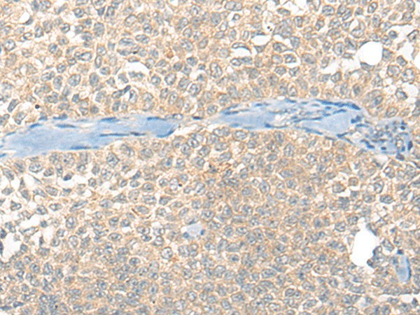 Immunohistochemistry of paraffin-embedded Human ovarian cancer tissue  using SNX6 Polyclonal Antibody at dilution of 1:40(?200)