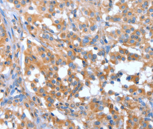 Immunohistochemistry of paraffin-embedded Human thyroid cancer tissue using NOD2 Polyclonal Antibody at dilution 1:40