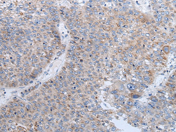 Immunohistochemistry of paraffin-embedded Human liver cancer tissue  using ENPP2 Polyclonal Antibody at dilution of 1:50(?200)