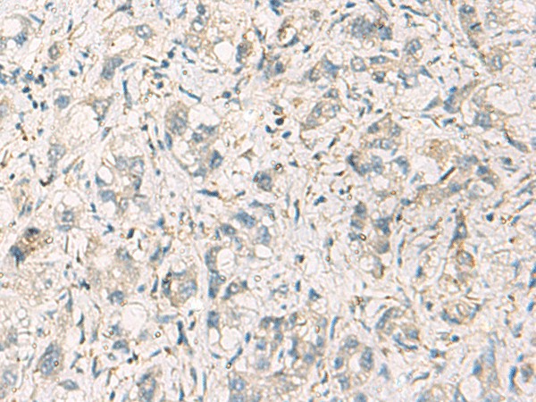 Immunohistochemistry of paraffin-embedded Human liver cancer tissue  using STX6 Polyclonal Antibody at dilution of 1:60(?200)