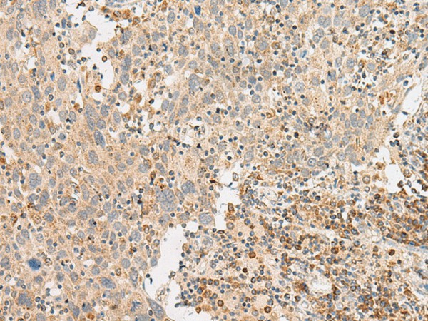 Immunohistochemistry of paraffin-embedded Human cervical cancer tissue  using GPR119 Polyclonal Antibody at dilution of 1:45(?200)