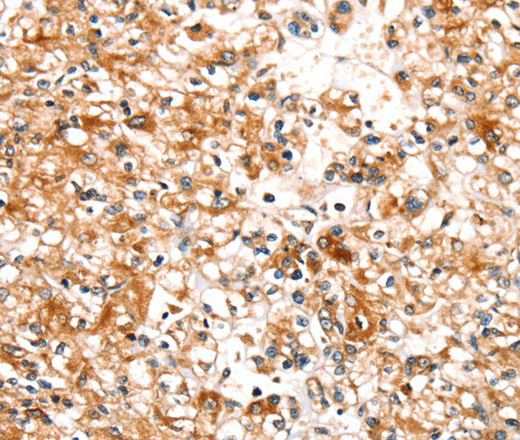 Immunohistochemistry of paraffin-embedded Human prostate cancer tissue using SLC25A12 Polyclonal Antibody at dilution 1:30