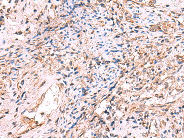 Immunohistochemistry of paraffin-embedded Human cervical cancer tissue  using OSBPL2 Polyclonal Antibody at dilution of 1:55(?200)