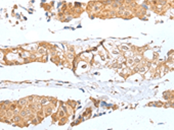 Immunohistochemistry of paraffin-embedded Human breast cancer tissue  using GLIPR1L1 Polyclonal Antibody at dilution of 1:25(?200)