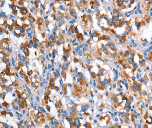 Immunohistochemistry of paraffin-embedded Human thyroid cancer tissue using CD226 Polyclonal Antibody at dilution 1:60