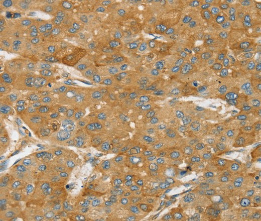 Immunohistochemistry of paraffin-embedded Human liver cancer using TPD54 Polyclonal Antibody at dilution of 1:35