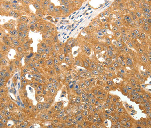 Immunohistochemistry of paraffin-embedded Human ovarian cancer tissue using TNN Polyclonal Antibody at dilution 1:50