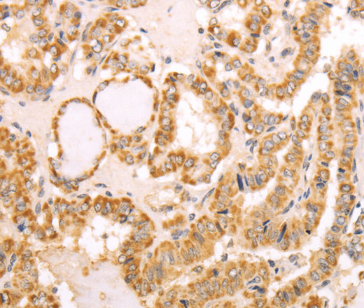 Immunohistochemistry of paraffin-embedded Human thyroid cancer using NAMPT Polyclonal Antibody at dilution of 1:30