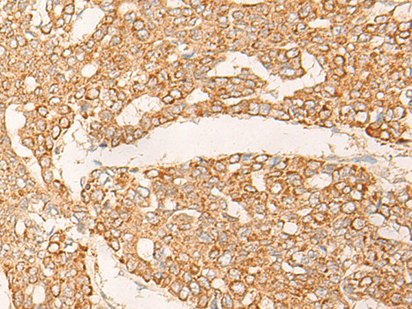 Immunohistochemistry of paraffin-embedded Human liver cancer tissue  using KRT9 Polyclonal Antibody at dilution of 1:30(?200)