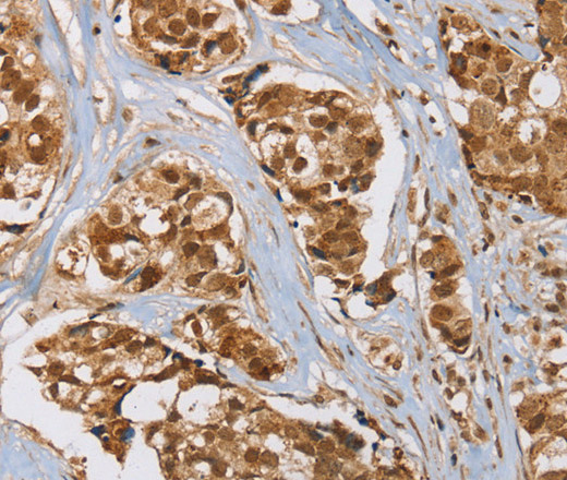 Immunohistochemistry of paraffin-embedded Human breast cancer tissue using RAB24 Polyclonal Antibody at dilution 1:45