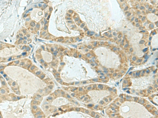 Immunohistochemistry of paraffin-embedded Human thyroid cancer tissue  using KLC2 Polyclonal Antibody at dilution of 1:120(?200)