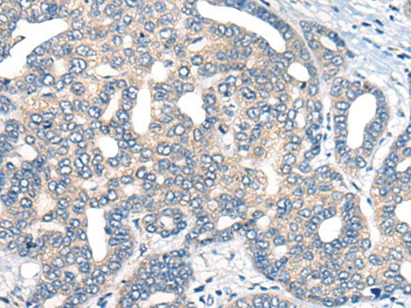 Immunohistochemistry of paraffin-embedded Human liver cancer tissue  using AURKA Polyclonal Antibody at dilution of 1:40(?200)