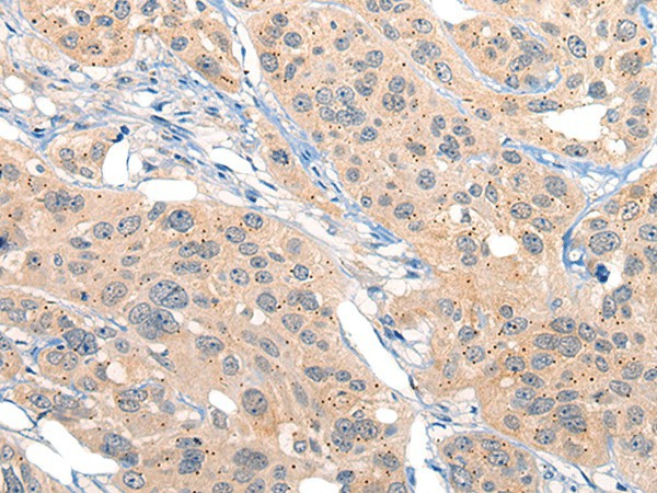 Immunohistochemistry of paraffin-embedded Human esophagus cancer tissue  using MIIP Polyclonal Antibody at dilution of 1:45(?200)