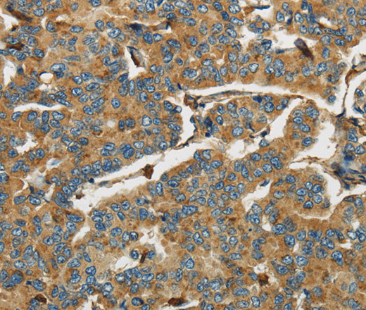 Immunohistochemistry of paraffin-embedded Human breast cancer using AIF1 Polyclonal Antibody at dilution of 1:40