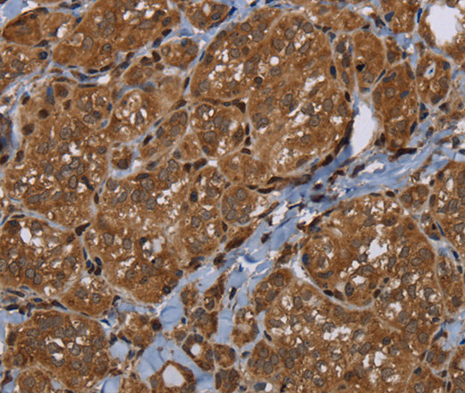 Immunohistochemistry of paraffin-embedded Human thyroid cancer using HSD17B4 Polyclonal Antibody at dilution of 1:30