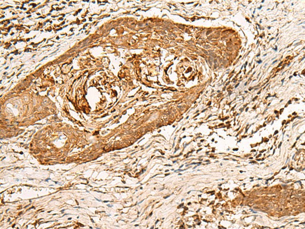 Immunohistochemistry of paraffin-embedded Human esophagus cancer tissue  using HIRIP3 Polyclonal Antibody at dilution of 1:60(?200)