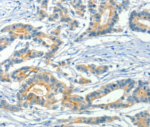 Immunohistochemistry of paraffin-embedded Human colon cancer using ASAH2 Polyclonal Antibody at dilution of 1:50